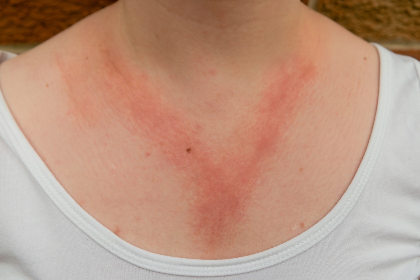 Sindrome Sistemica da Allergia al Nichel 